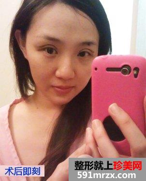 做双眼皮手术恢复时间多长
