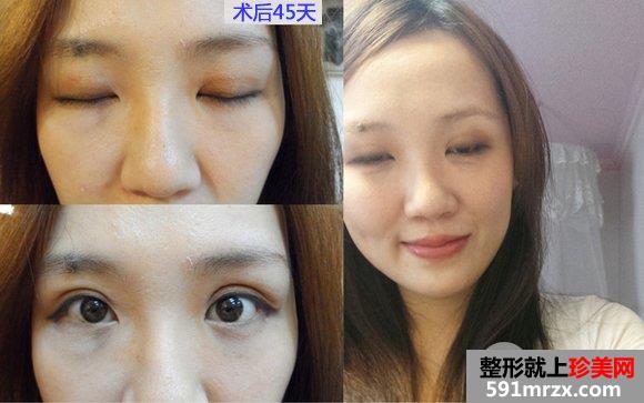 做双眼皮手术恢复时间：第30天