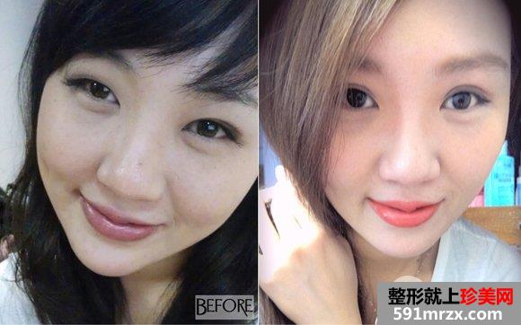 双眼皮手术前后的对比照