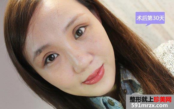 做双眼皮手术恢复时间：第30天