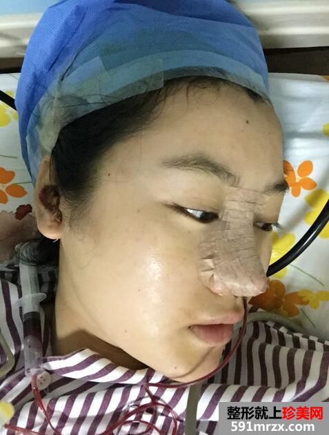 【刘志刚鼻综合】膨体加自体耳软骨垫鼻尖【诗颜网】