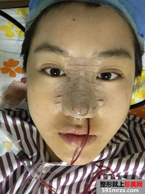 【刘志刚鼻综合】膨体加自体耳软骨垫鼻尖【诗颜网】