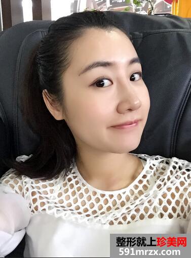 【刘志刚鼻综合】膨体加自体耳软骨垫鼻尖【诗颜网】