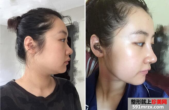 【刘志刚鼻综合】膨体加自体耳软骨垫鼻尖【诗颜网】