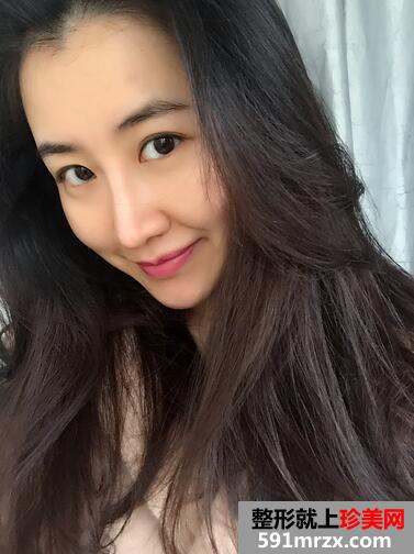 【刘志刚鼻综合】膨体加自体耳软骨垫鼻尖【诗颜网】