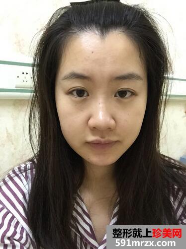【刘志刚鼻综合】膨体加自体耳软骨垫鼻尖【诗颜网】