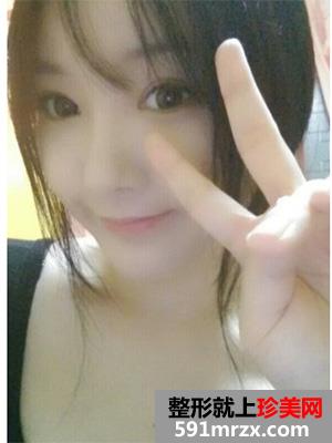 晒一下我的去颊脂垫前后对比照片 天壤之别啊
