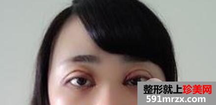 割自然平行双眼皮7mm宽效果图全过程分享