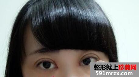 割自然平行双眼皮7mm宽效果图全过程分享