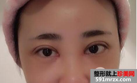 割自然平行双眼皮7mm宽效果图全过程分享