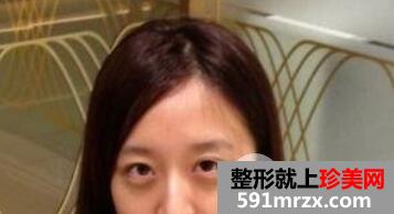 双眼皮修复+上睑提肌成功案例手术前后对比图片