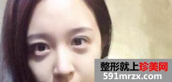 双眼皮修复+上睑提肌成功案例手术前后对比图片