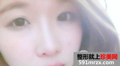 割全切双眼皮假体隆鼻全过程恢复图片记录