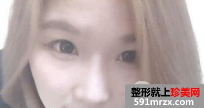 割全切双眼皮假体隆鼻全过程恢复图片记录