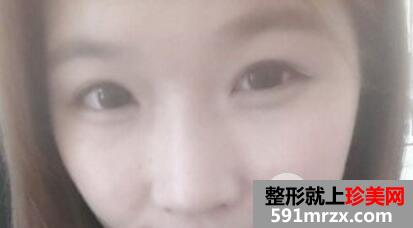 割全切双眼皮假体隆鼻全过程恢复图片记录