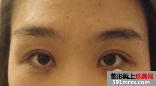 切开法双眼皮+开内眼角+外切法去眼袋整形手术效果图