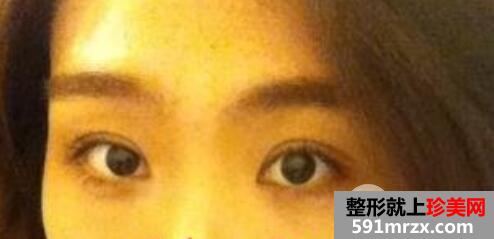 切开法双眼皮+开内眼角+外切法去眼袋整形手术效果图