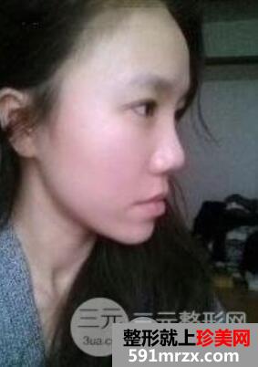 自体脂肪丰额头全过程+效果前后对比图
