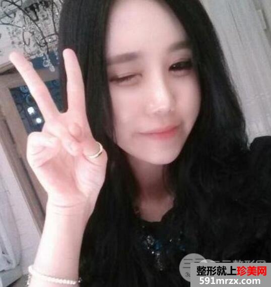 自体脂肪丰额头全过程+效果前后对比图