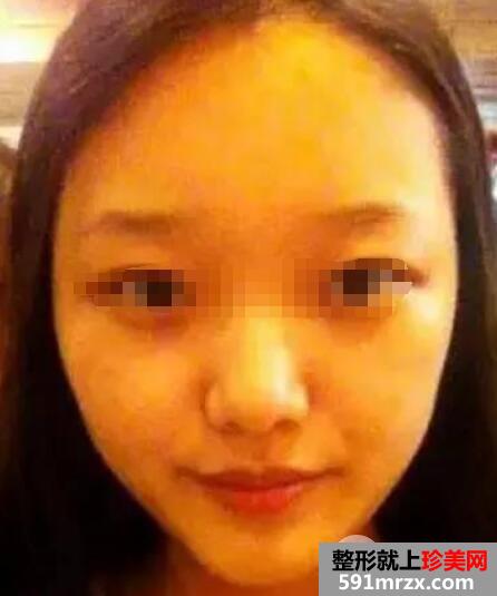 鼻综合整形手术案例真实恢复经历自然效果图