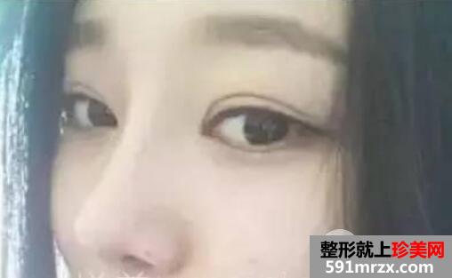 鼻综合整形手术案例真实恢复经历自然效果图