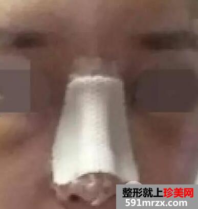 鼻综合整形手术案例真实恢复经历自然效果图