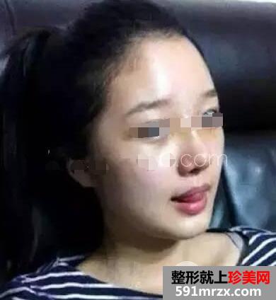 鼻综合整形手术案例真实恢复经历自然效果图
