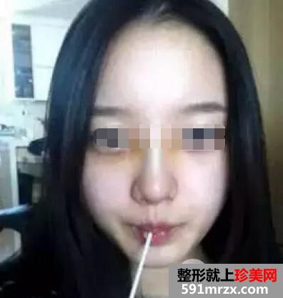 鼻综合整形手术案例真实恢复经历自然效果图