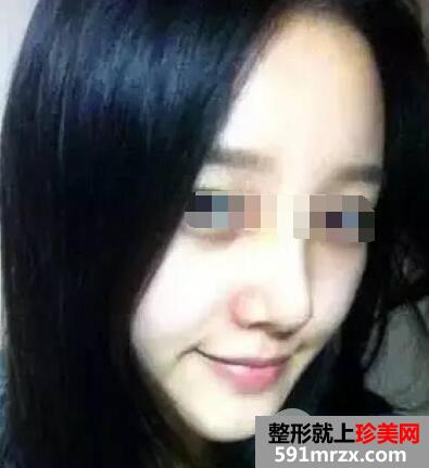 鼻综合整形手术案例真实恢复经历自然效果图