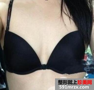 自体脂肪隆胸效果如何真实案例恢复期全过程