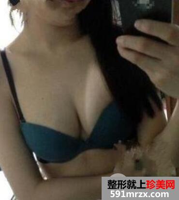 自体脂肪隆胸效果如何真实案例恢复期全过程