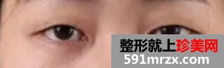 双眼皮加开眼角手术2个月恢复期效果过程图