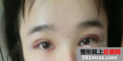 双眼皮加开眼角手术2个月恢复期效果过程图