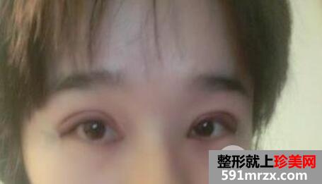 双眼皮加开眼角手术2个月恢复期效果过程图