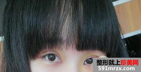 双眼皮加开眼角手术2个月恢复期效果过程图