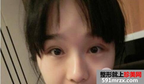 双眼皮加开眼角手术2个月恢复期效果过程图