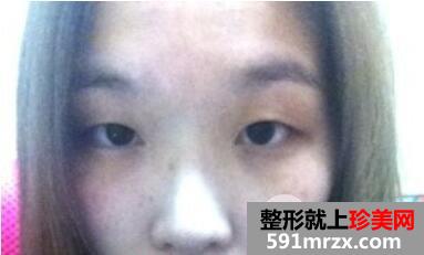 韩式双眼皮隆鼻一起做经历前后对比照恢复图片