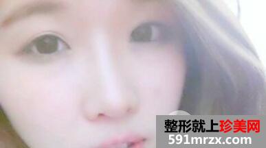 韩式双眼皮隆鼻一起做经历前后对比照恢复图片