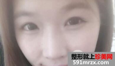 韩式双眼皮隆鼻一起做经历前后对比照恢复图片