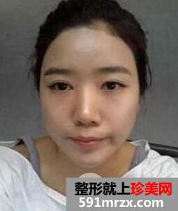 卧蚕眼整形手术过程效果图片对比美女大眼速成