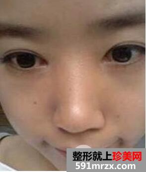 卧蚕眼整形手术过程效果图片对比美女大眼速成