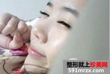 卧蚕眼整形手术过程效果图片对比美女大眼速成