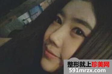 卧蚕眼整形手术过程效果图片对比美女大眼速成