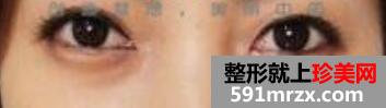 6激光去除黑眼圈手术全过程真实案例前后对比照