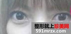 激光去除黑眼圈手术全过程真实案例前后对比照