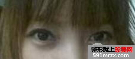 激光去除黑眼圈手术全过程真实案例前后对比照