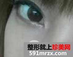 激光去除黑眼圈手术全过程真实案例前后对比照