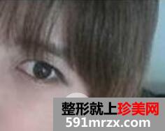 激光去除黑眼圈手术全过程真实案例前后对比照