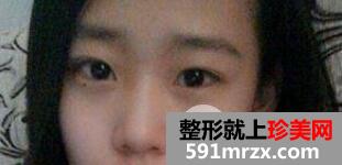 韩式切开法双眼皮手术全过程附前后恢复对比图片