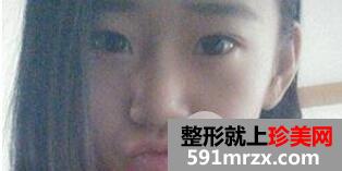 韩式切开法双眼皮手术全过程附前后恢复对比图片